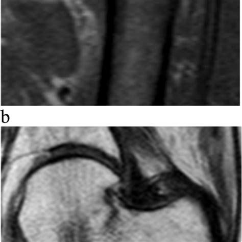 Mri Of The Same Occult Femoral Neck Fracture A T2 Weighted