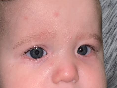 We did not find results for: Flat Nasal Bridge And Epicanthal Folds : Strabismus In ...