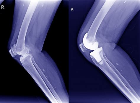 Premium Photo X Ray Right Osteoarthritis Of Kneeoa And Post