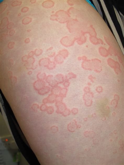 Chronic Urticaria Article