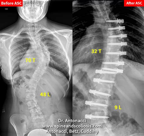 Kh 14yo 70 Thoracic After Asc Double Curve Scoliosis Surgery