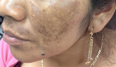 Derm Dx Brown Patches On The Face Clinical Advisor
