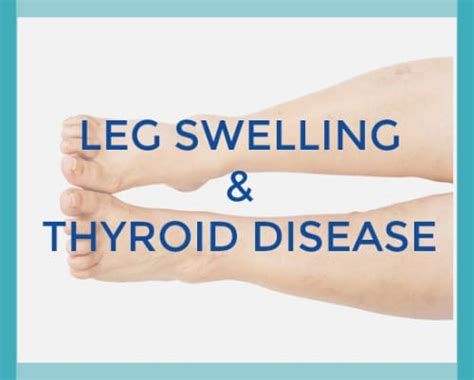 Leg Swellingthyroid Disease Holistic Thyroid Care