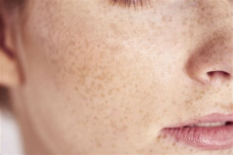 Freckles Removal With Ipl Skin Rejuvenation Dermacore Telford