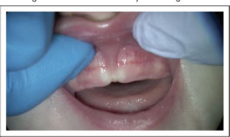 Figure 2 From Diagnosing And Understanding The Maxillary Lip Tie Superior Labial The Maxillary
