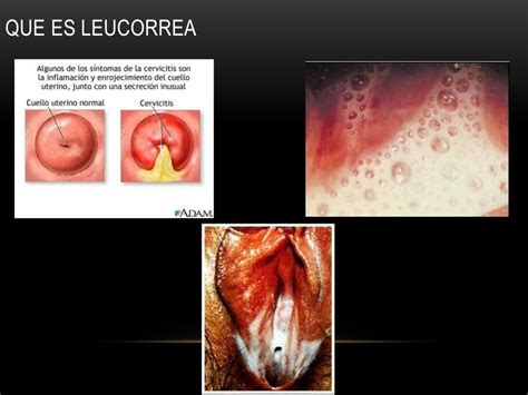 Leucorrea Vaginosis Vaginitis Cervicitis