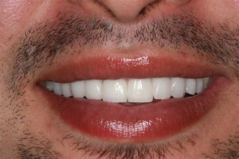 Mens Hollywood Smile Pretty Teeth Dental Veneers Smile Makeover