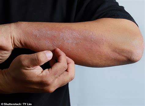 Coronavirus Skin Rashes Are A Symptom For One In 11 Patients