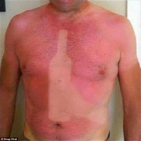 Sunburn Images Show Epic Tan Fails And Bruised Egos To Match Daily