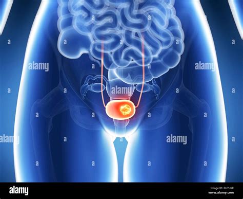 Human Bladder Cancer Illustration Stock Photo Alamy
