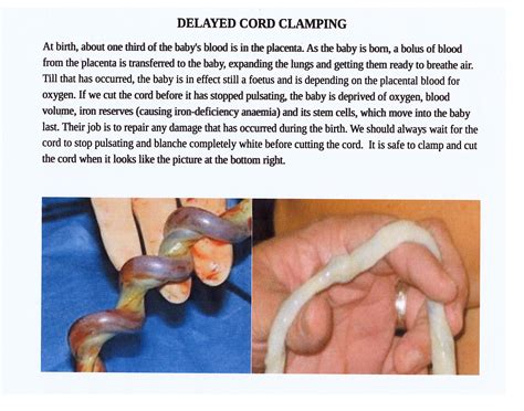 Pin On Stopping Premature Cord Clamping