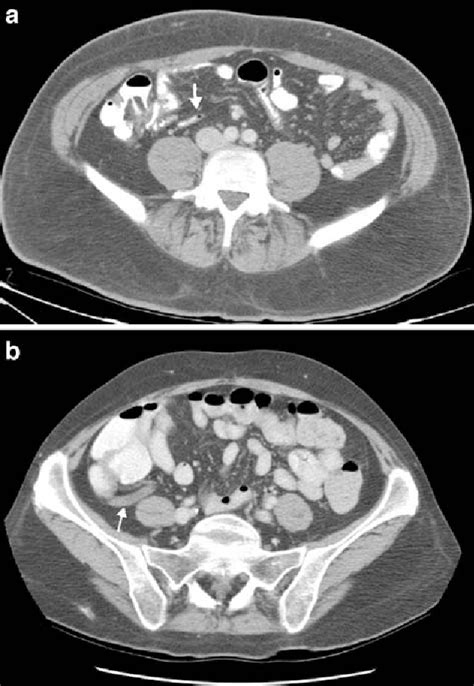 Ct Appearance Of The Normal Appendix In Adults Semantic Scholar