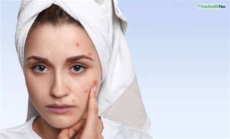 Boil Vs Pimple What Is The Difference True Health Tips