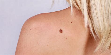 Moles How To Check That They Are Not Cancerous