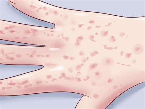 3 Ways To Heal Dry Cracked Hands Wikihow Dry Cracked Hands Chronic