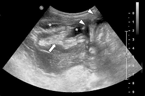 Percutaneous Ultrasonography Guided Drainage Of Intraperitoneal Fluid