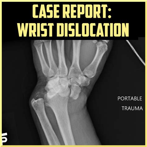 Wrist Dislocation Following A Motorcycle Crash Sports Medicine Review