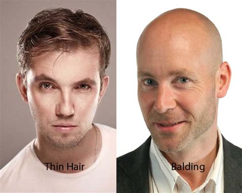Hair thinning is not the same as going bald. Thin Hair vs Balding | iLookWar.com