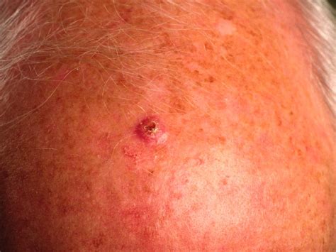Zelfonderzoek Van Uw Huid Na Plaveiselcelcarcinoom Patiëntenfolder