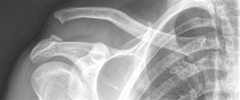 Ac Joint Dislocation Ac Joint Injury Orthopaedic Shoulder Surgeon Perth