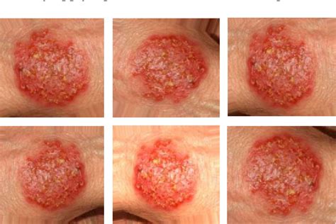 Figure 2 From Differential Diagnosis Of Ringworm And Eczema Using Image