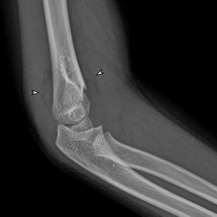 Elbow Joint Effusion Radiology Reference Article Radiopaedia Org