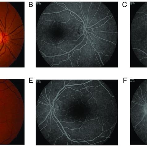 Fundus Photography And Fluorescein Angiography After The Iud Was
