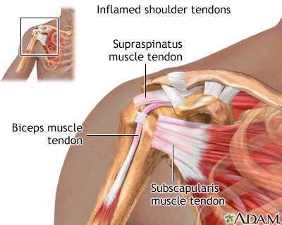 The tendons of the rotator cuff muscles fuse into one structure at or near their tuberosity insertions. Inflamed shoulder tendons: MedlinePlus Medical ...