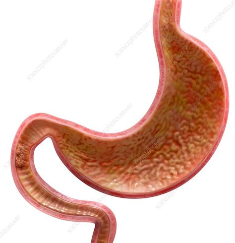 cancer of the small intestine illustration stock image c034 2675 science photo library