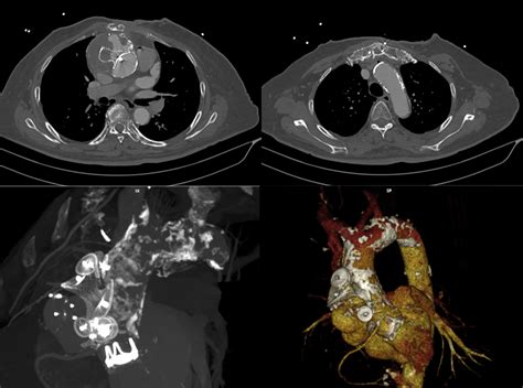 First In Human Endo Bentall Procedure For Simultaneous Treatment Of The