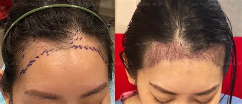 Patient Gets Hairline Lowering Surgery Jae Pak Md Medical