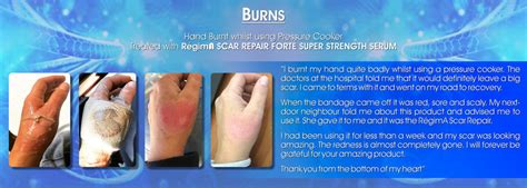 Before And After Burns And Trauma Regima Uk