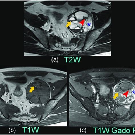 Mri On T2 Weighted Image A And T1 Weighted Image B Shows A