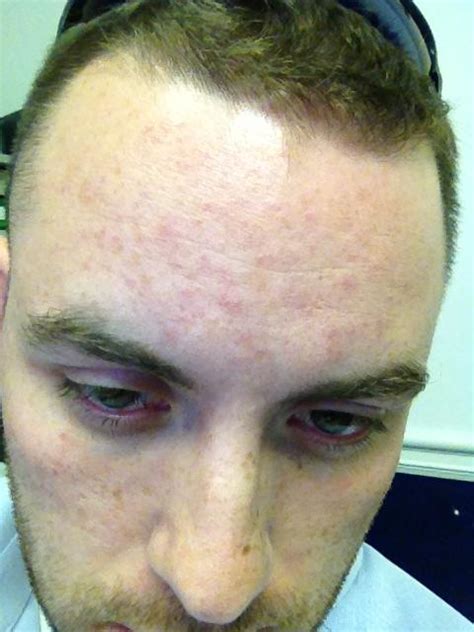 Herpes simplex 2 is one of the two viruses that cause herpes. Suddenly got a rash on my forehead! Any help? : Dermatology