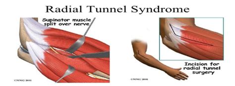 Radial Tunnel Syndrome Surgery Singapore Sports Clinic
