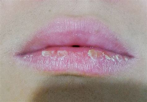 嘴唇干裂脱皮是什么原因引起的？ 优刊号