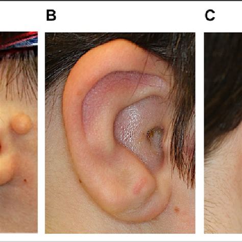 Preoperative Image Of Auricle With Congenitally Absent Lobule A