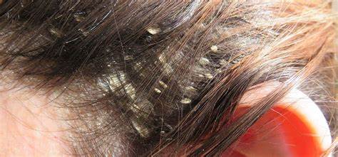 Instructions to Treat Chronic Dandruff, What Is It, And Causes