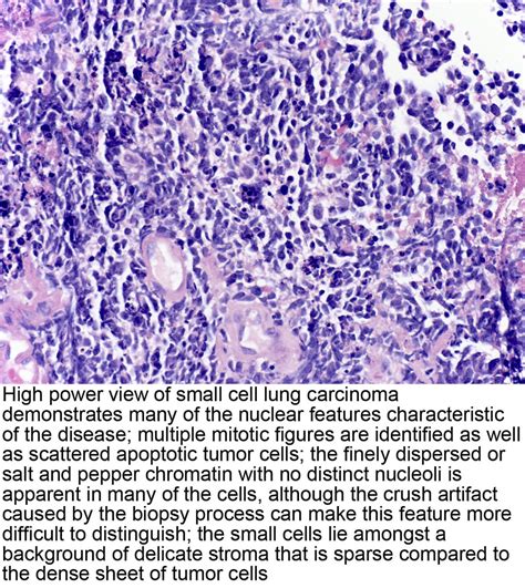 Pathology Outlines Small Cell Carcinoma