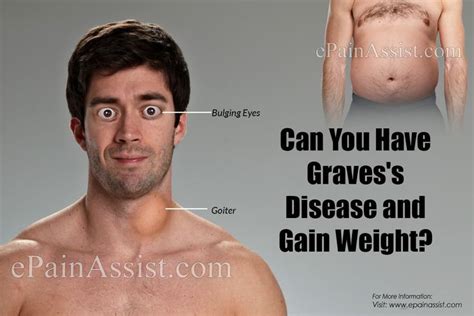 Can You Have Gravess Disease And Gain Weight Graves Disease Graves