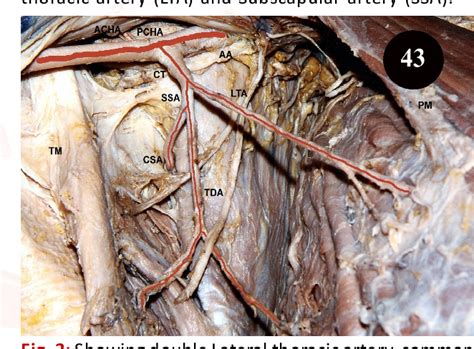 Subscapular Artery Cadaver