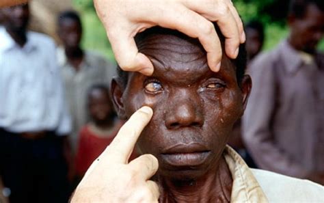 What Do Blind Peoples Eyes Look Like