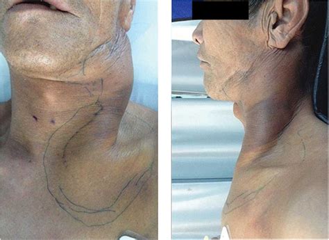 Dissection of right side of neck showing variations in branching pattern of external carotid artery. Management of extracranial carotid artery aneurysm: A ...