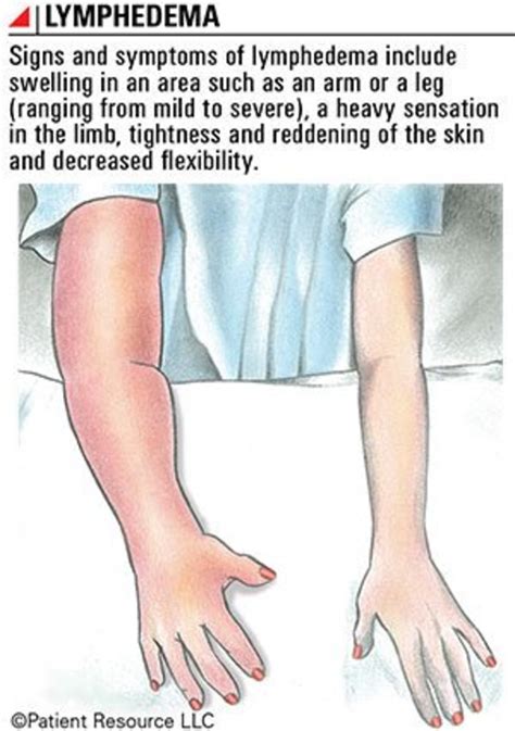 Lymphedema What It Is And How To Treat It Hubpages