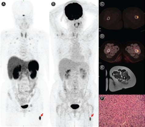 Comparison Of 18f‐fdg Petct And 68ga‐dotatate Petct In The Targeted