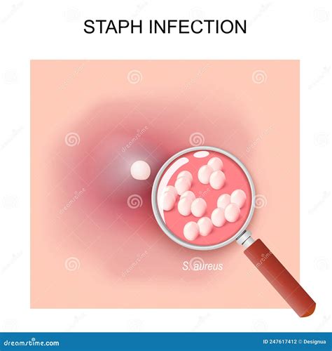 Staph Infection Acne Stock Vector Illustration Of Epidermis 247617412