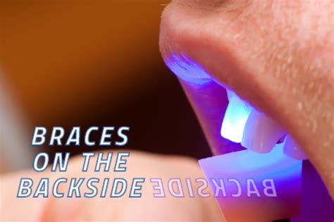 Get Your Braces On The Backside In Atlanta Ga Chamblee Orthodontics