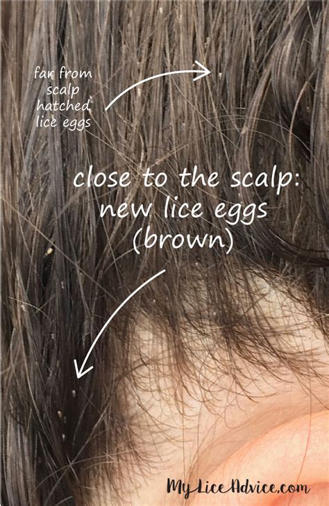 48 Best Pictures What Does Lice Look Like In Black Hair