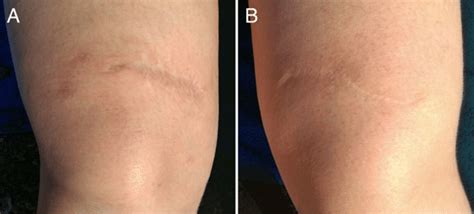 Fourteen Months After Surgical Revision During Which The Scar Tissue