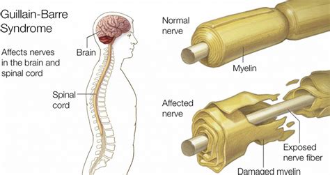 Willison h.j., jacobs b.c., van doorn p.a. Guillain-Barré Syndrome(GBS): Causes, Symptoms, Diagnosis & Treatment » How To Relief